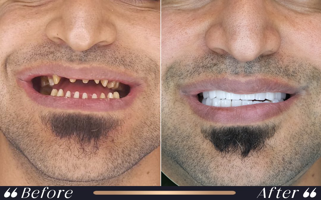 Zirconia Crowns zirconia crowns in veneers vs zirconium crowns comparison