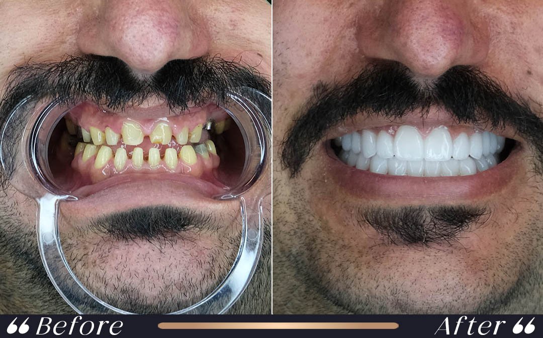 Veneers vs Zirconium Crowns at Yesilkoy Clinic veneers vs zirconium crowns professional dental treatment at Yesilkoy Clinic