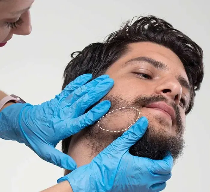 Beard Transplant at Yesilkoy Clinic