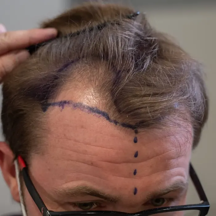 DHI Hair Transplant at Yesilkoy Clinic