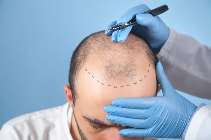 Hair Transplant at Yesilkoy Clinic