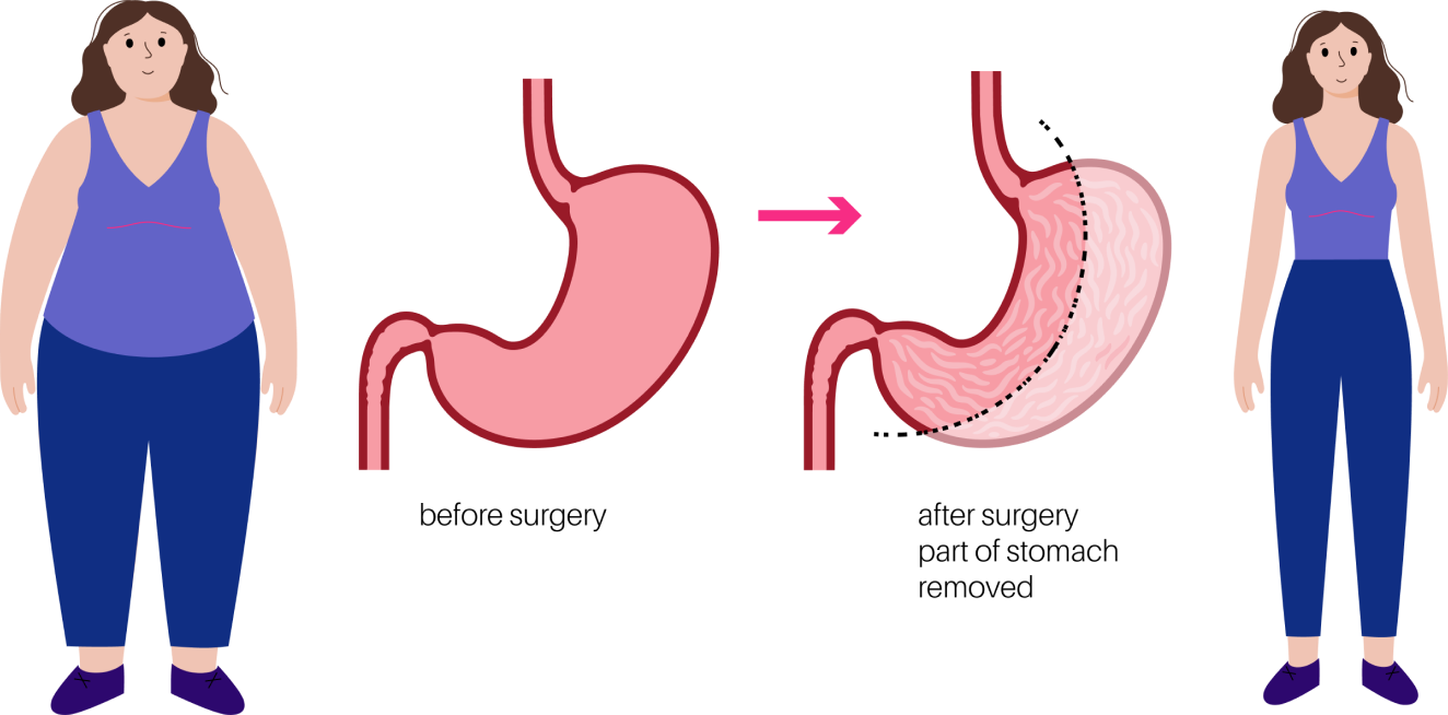 Gastric Balloon vs Gastric Sleeve gastric balloon vs gastric sleeve comparison at Yesilkoy Clinic