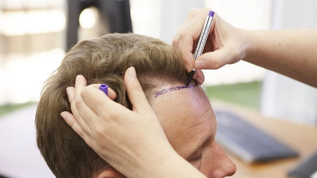 FUE vs DHI at Yesilkoy Clinic fue vs dhi professional hair transplant at Yesilkoy Clinic